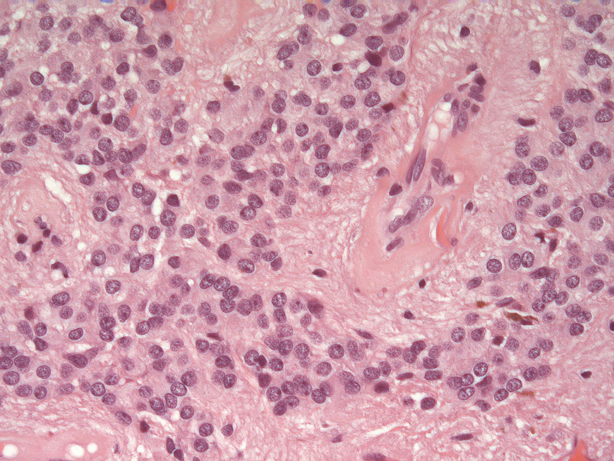 Corte histol&oacute;gico de tumor s&oacute;lido pedi&aacute;trico