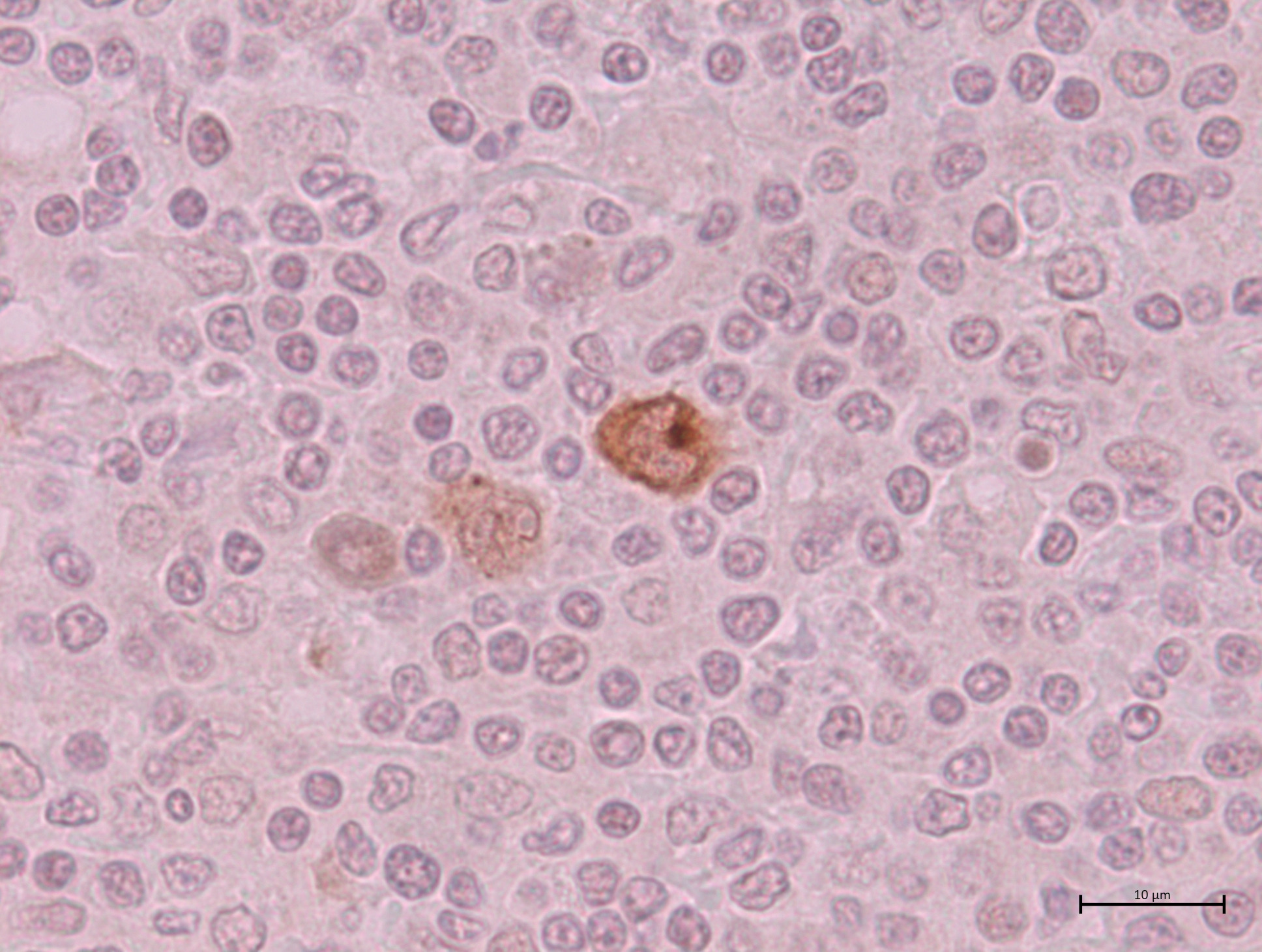 Tejido linfoide con marcación para virus de Epstein-Barr
